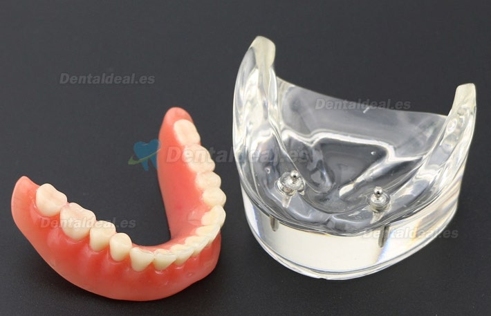 Dental Dientes inferiores Modelo de sobredentadura 2 Implantes Demostración Modelo 6002 01